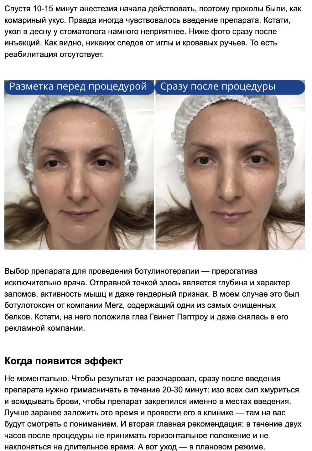 Beauty Hunter пробует ботулинотерапию у нас - экспертные публикации в СМИ |  Клиника Beauty Trend