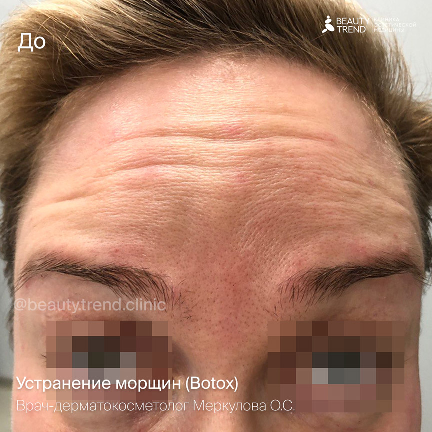 Botox, Меркулова - до 1