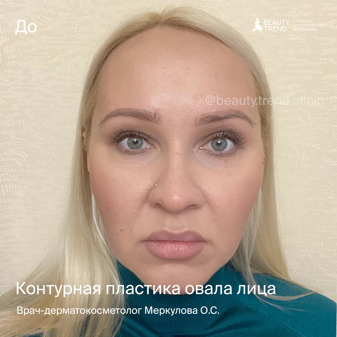 Моделирование овала лица филлерами в Москве по цене от 21855 руб. в клинике  Beauty Trend