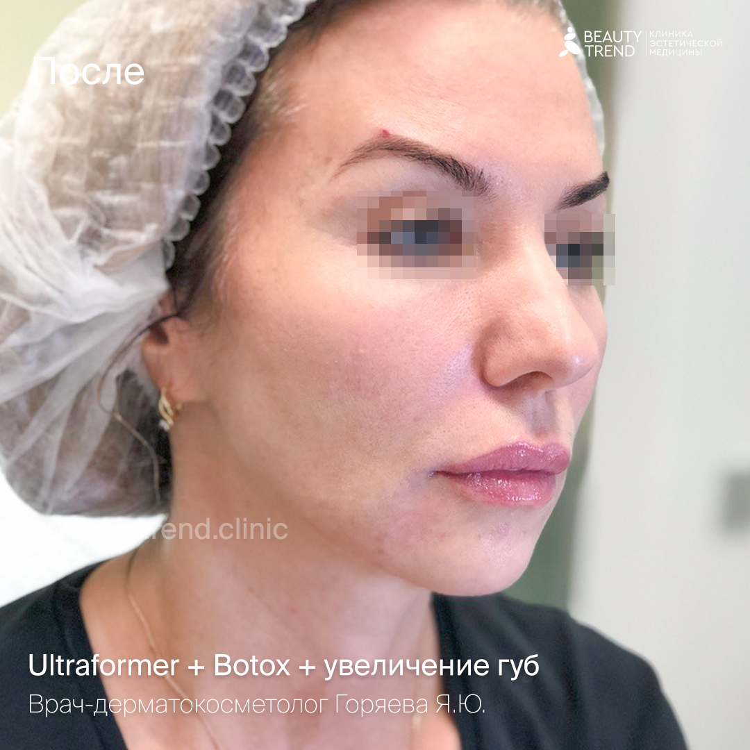 Устранение морщин (Botox, Dysport)