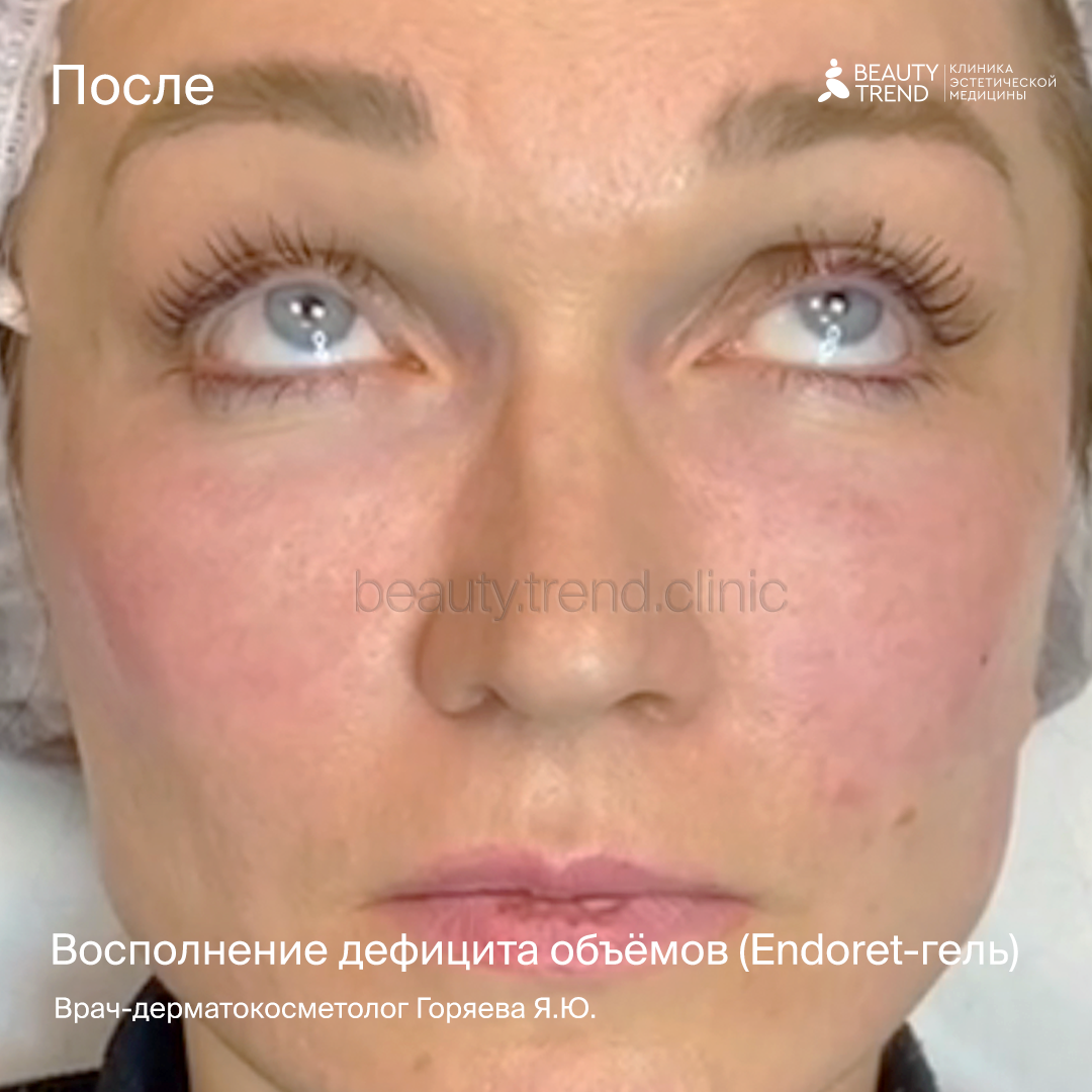 Поазмо лифтинг до и после. Плазмогель для лица отзывы. Плазмогель для лица отзывы. Поазмо лифтинг до и после. Плазмолифтинг для лица.