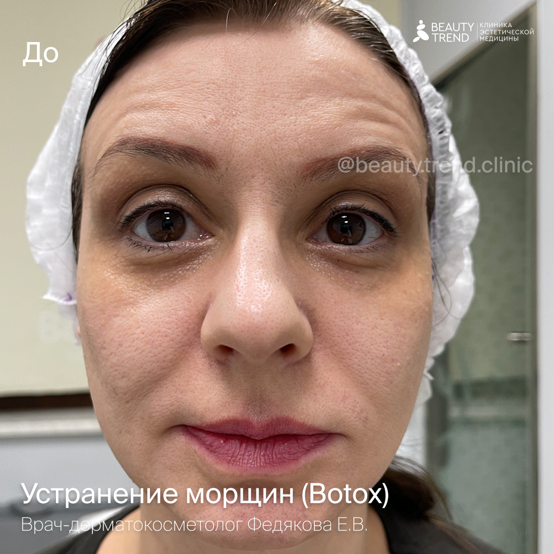 Ботулинотерапия, цены на ботулинотерапию за единицу в Клинике Beauty Trend  в Москве