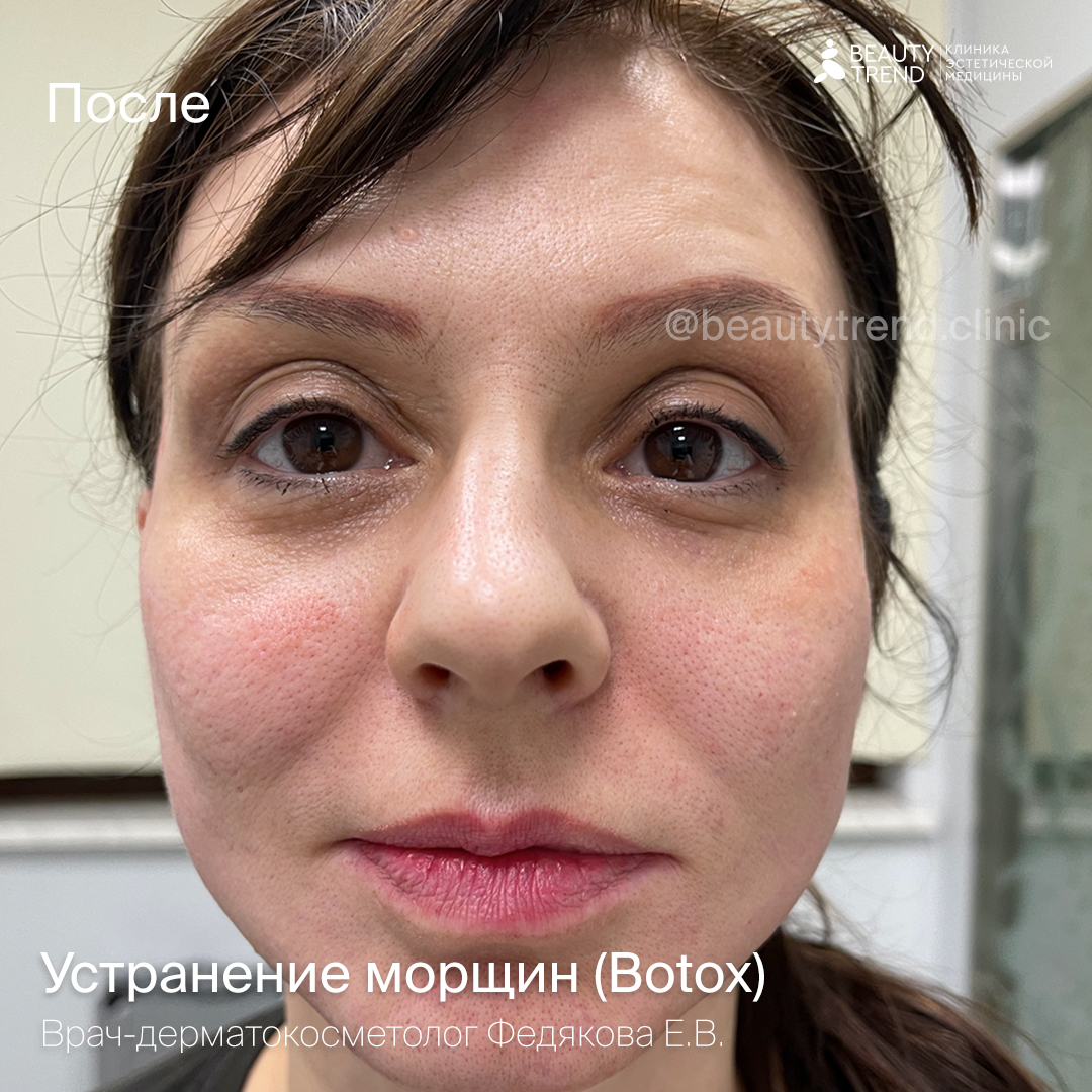 Устранение морщин (Botox, Dysport)