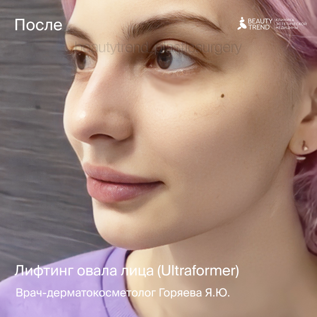 Ультразвуковой лифтинг (Ultraformer III) в Москве по цене от 38000 руб. в  клинике Beauty Trend