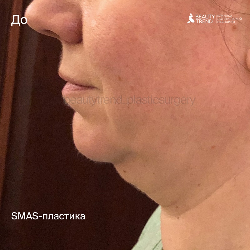 SMAS-пластика лица, 6А - до 1