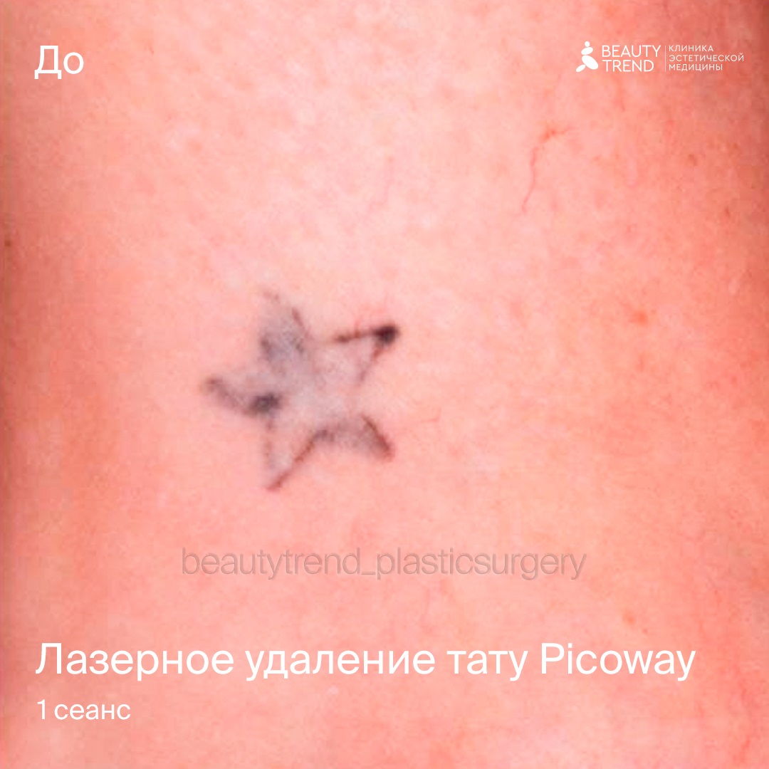 удаление тату пикосекундным лазером. лазерное удаление тату. удаление тату пикосекундным лазером. пикосекундный лазер результаты. ощущения от удаления тату лазером.