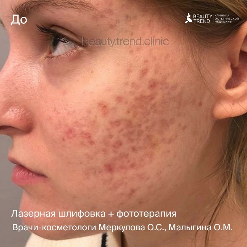 Лечение постакне - до 1