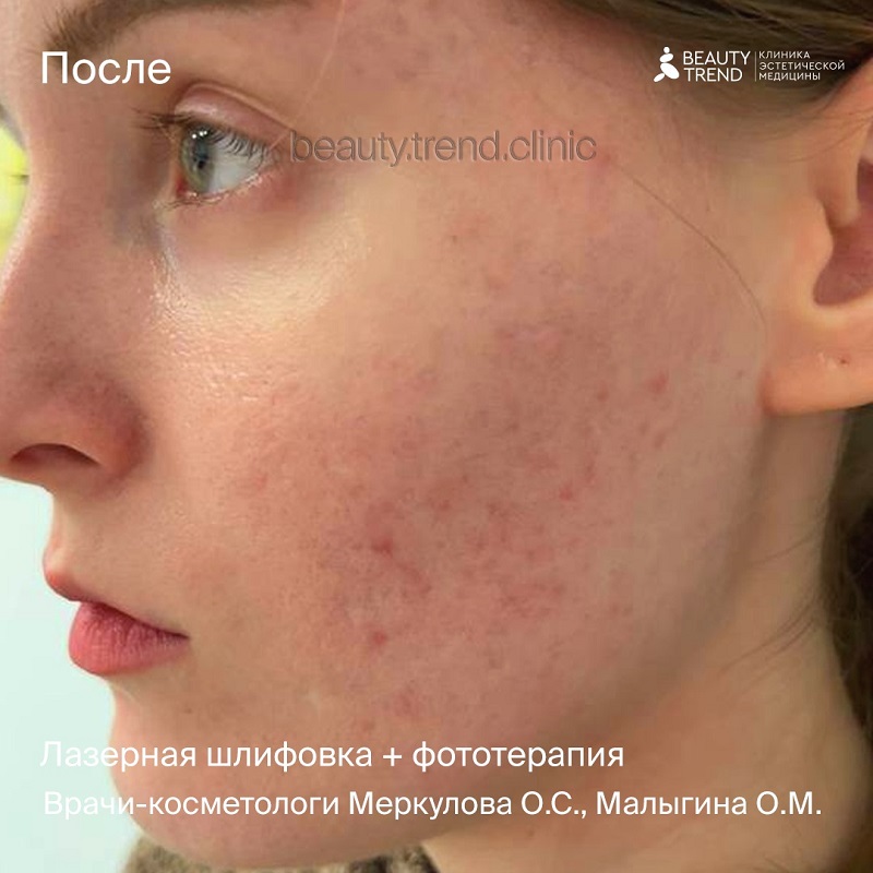 Лечение постакне - после 1