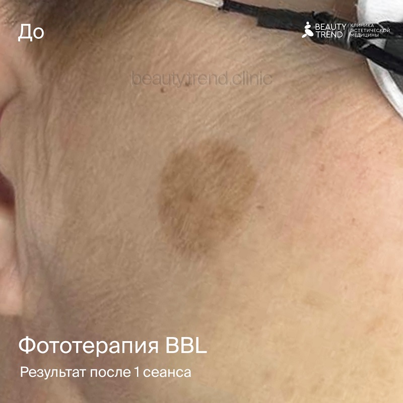 BBL, 2М - до 1