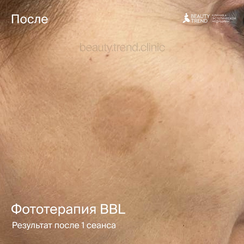 BBL, 2М - после 1