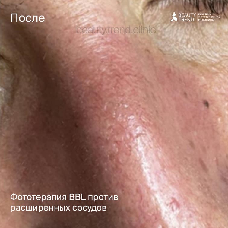 ББЛ против сосудов на носу - после 1