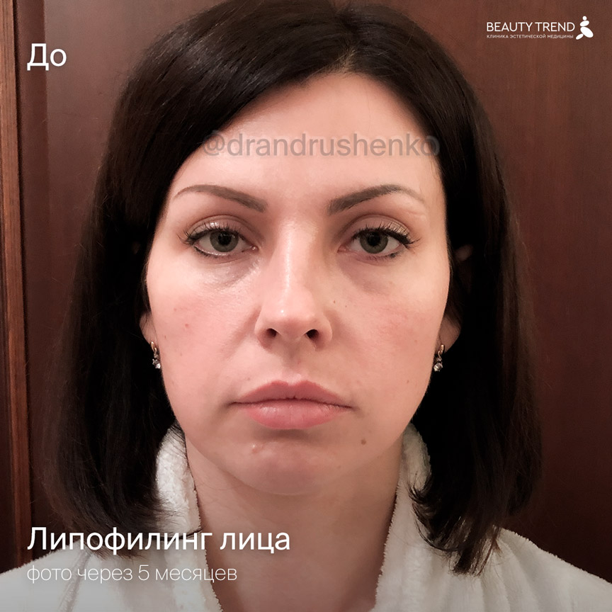Липофилинг Лица Фото До И После Цена