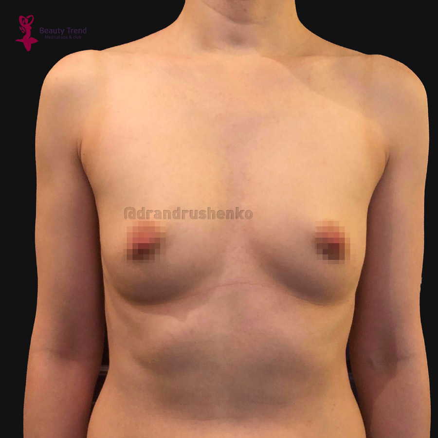 Увеличение груди имплантами, 1А - до
