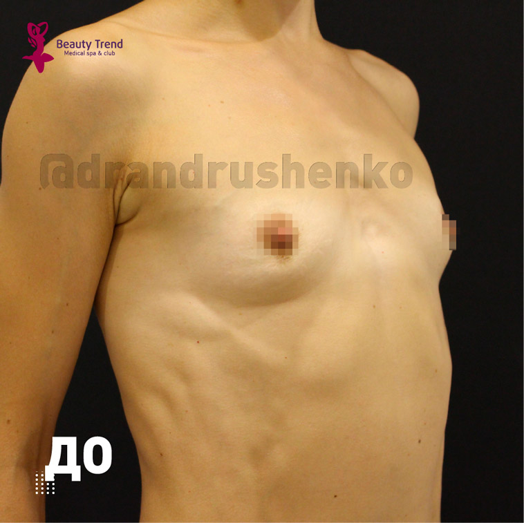 Увеличение груди имплантами, 2А - до
