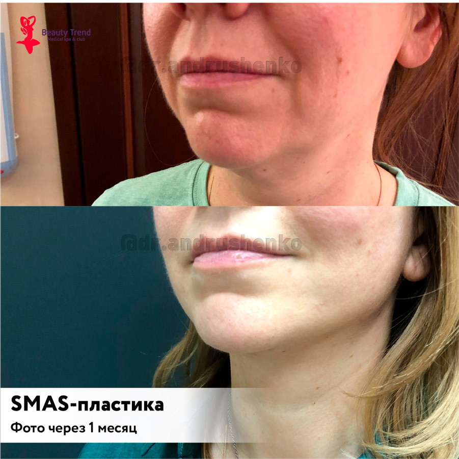 SMAS-пластика лица, 6А - 1