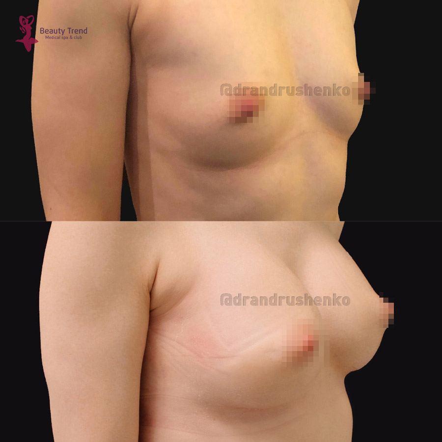 Увеличение груди имплантами, 1А - 2