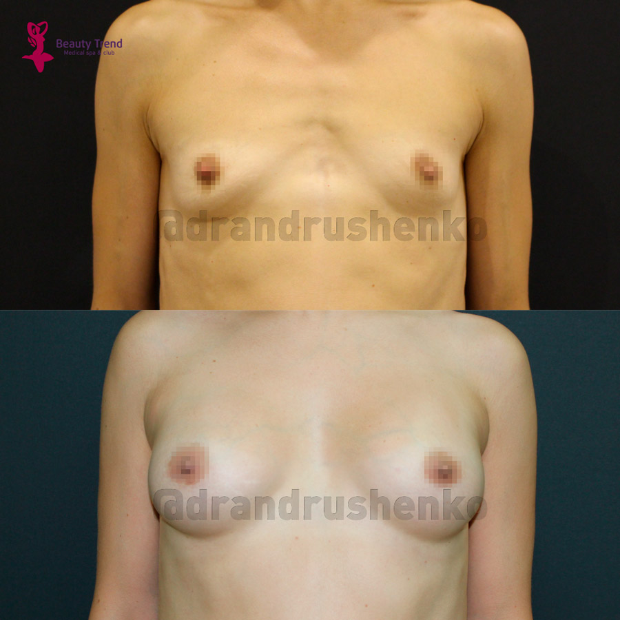 Увеличение груди имплантами, 2А - 2