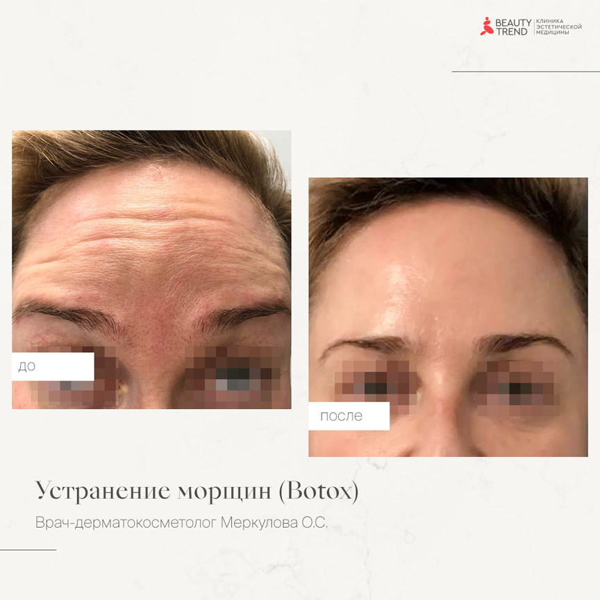 Botox, Меркулова - 1